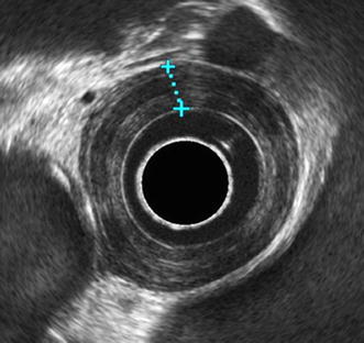 endoscopic ultrasound guided biopsy pancreas