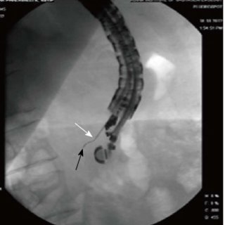 endoscopic ultrasound guided biopsy pancreas